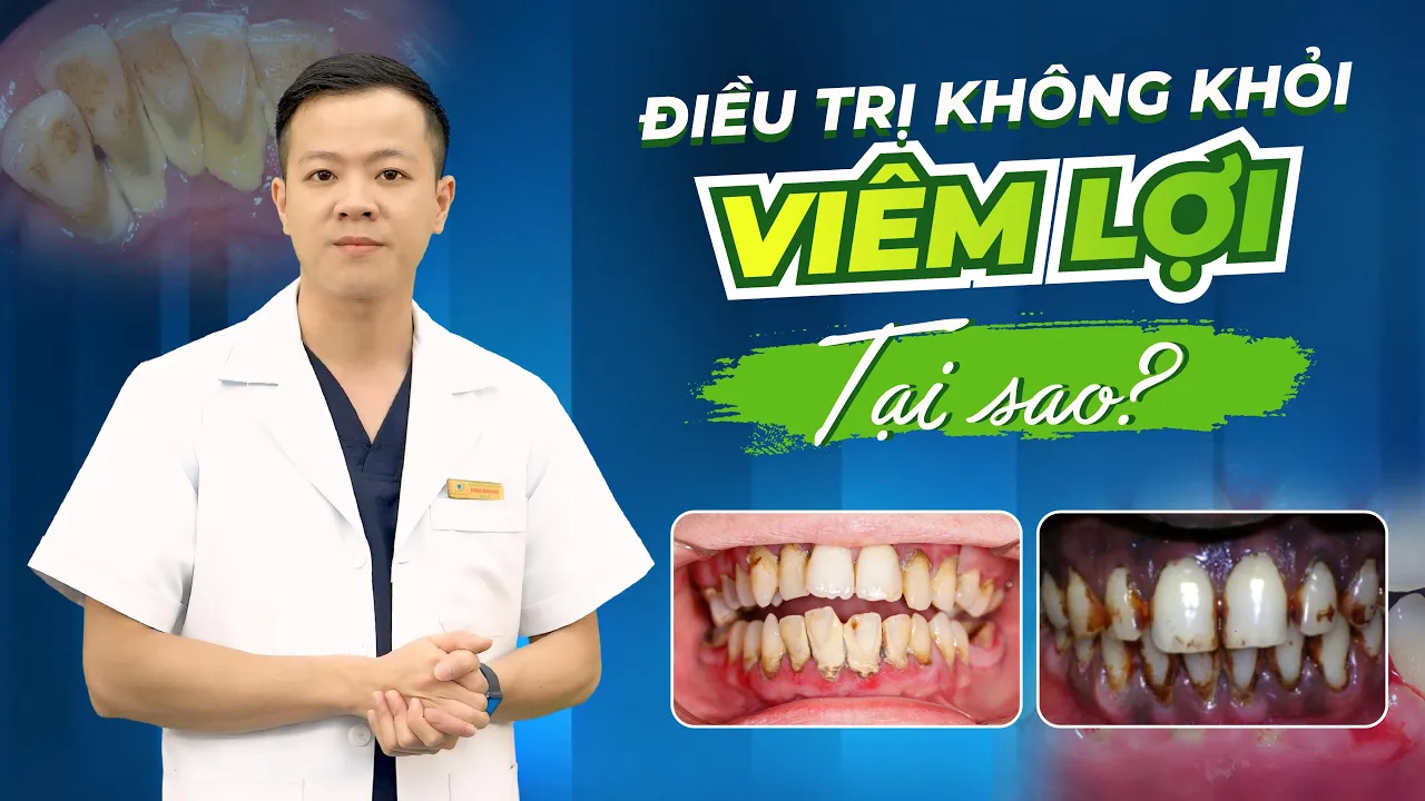Outline Video ĐIỀU TRỊ VIÊM LỢI KHÔNG KHỎI, TẠI SAO VẬY? NGUYÊN NHÂN DO ĐÂU?