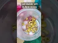 Download Lagu Gall bladder with Multiple stones #healthmedia