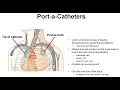 24 Principles of Port A Cath Placement Management