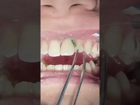 Class IV composite restoration for upper central tooth #dentist