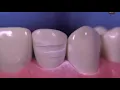 Veneers