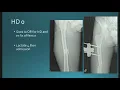 Download Lagu Controversies in timing of surgical intervention in orthopaedic trauma - current evidence