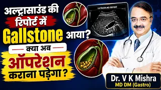 अल्ट्रासाउंड की रिपोर्ट में Gallstone आया? क्या अब ऑपरेशन कराना पड़ेगा?