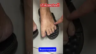  อาการของโรคเก๊าท มีอะไรบ้าง 