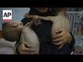 Download Lagu Starvation attacks bodies of malnourished children in Gaza