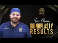 This Rhinoplasty will blow your mind Excellent rhinoplasty Results Dr Alonso - Vive Plastic Surgery