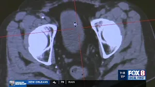 Ochsner Prostate Cancer New Treatment Options