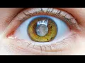 Blurry Vision After Cataract Surgery? Causes & Solutions Explained Urdu/Hindi