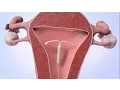 Patient Education Intrauterine Device IUD