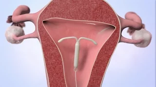 Patient Education Intrauterine Device IUD