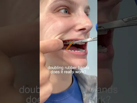 Doubling Your Rubber Bands For Braces - Does It Really Work? 🤔