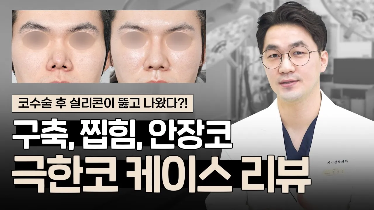 [극한코 케이스 리뷰] 염증,구축코, 콧구멍 찝힘, 패임, 안장코｜코재수술 전과 2개월 후 모습은?  [JP SUB]