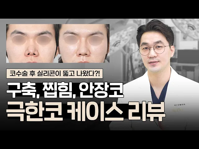[극한코 케이스 리뷰] 염증,구축코, 콧구멍 찝힘, 패임, 안장코｜코재수술 전과 2개월 후 모습은?  [JP SUB]