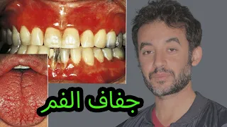 إزاى عالجت حالة جفاف الفم                   دندنها