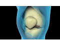 Total Knee Replacement Surgery Nucleus Health