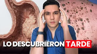 Pensaron que era gastritis durante meses, hasta que descubrieron un cáncer de estómago