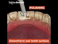 Download Lagu Teeth Cleaning removes stains and yellow color Tartar