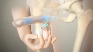 دعامات القضيب الهيدروليكيه الدكتور محمد حمدان دندنها