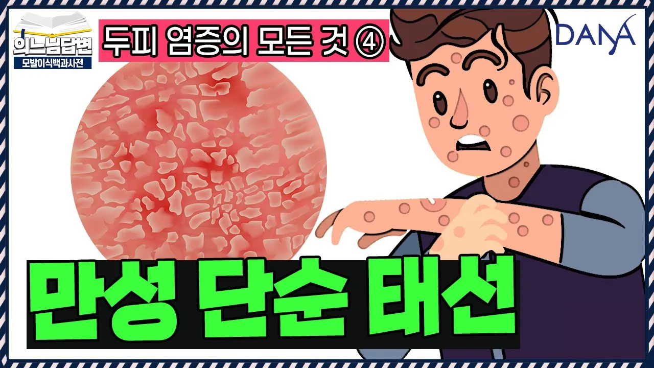 의느님답변📂만성 단순 태선😫원인과 치료방법ㅣ두피 염증의 모든 것④ - 만성 단순 태선ㅣ다나성형외과(DANA)ㅣ모발이식ㅣ헤어라인교정ㅣ두피문신ㅣ탈모치료