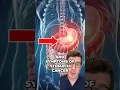 STOMACH CANCER - 9 potential signs and symptoms #shorts #health