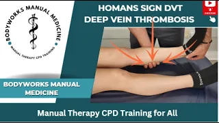 Homans Sign for Deep Vein Thrombosis DVT