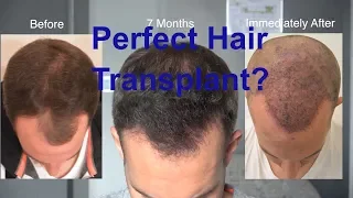 The Perfect FUE Natural Hair Transplant? 2700 Grafts @ 7 Months