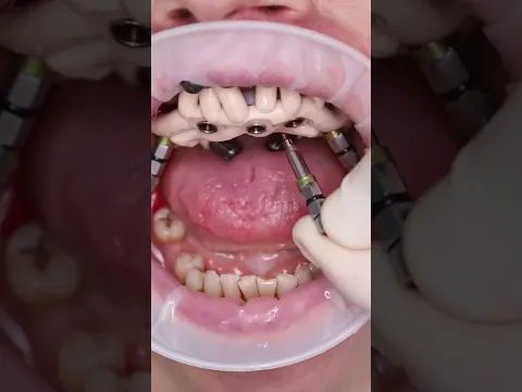 Full mouth implants done in one day #shorts #dentist #transformation