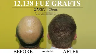 FUE Hair transplant result (12,138 Scalp grafts)- Dr Zarev, Bulgaria