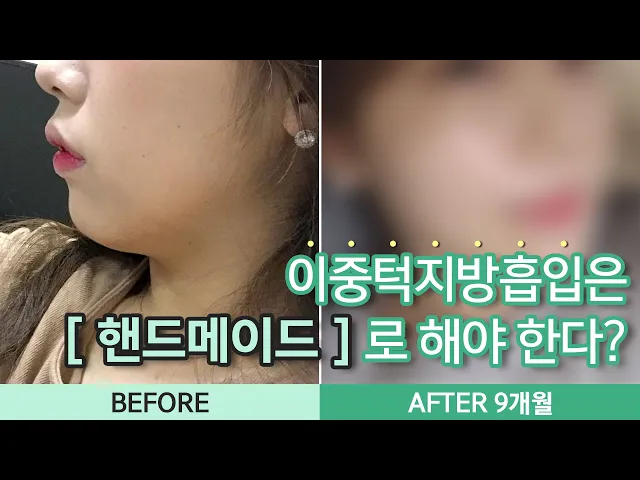 이중턱지방흡입은 핸드메이드로 해야 효과가 있다고?