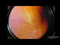 How to calculate CD ratio in glaucoma