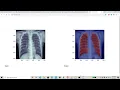 Multi Crop Convolutional Neural Networks for Fast Lung Nodule Segmentation - PYTHON PROJECTS 2021 22