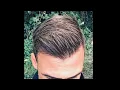 Download Lagu HAIR TRANSPLANT With 4500 Grafts NW4-5, Excellent Result With Fine Hair !