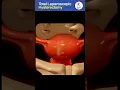 Total Laparoscopic Hysterectomy Complete Animation Dr Deepika Singh