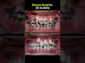 Download Lagu Braces for crowded teeth #braces #orthodontist #dentistry #dentist