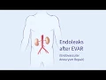Endoleaks after Endovascular Repair of Thoracic Aortic Aneurysms EVAR