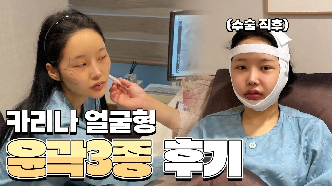 카리나 얼굴형, 윤곽3종 수술전 영상 공개💕