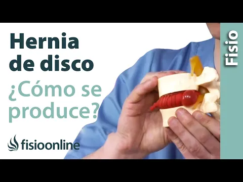 vídeo relacionado con ¿Qué es una hernia discal lumbar? Síntomas, causas y tratamiento