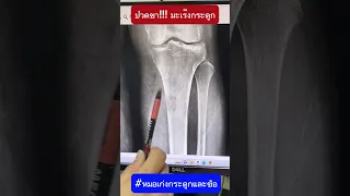  ทำไมคนไข้ถึงมีอาการปวดที่หน้าแข้ง และเกิดการเสื่อมของกระดูกตรงบริเวณนั้น 