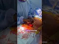 Lagu Come To Surgery With Me| Dermoid Cyst #surgeryrecovery #fibroids #fibroidawareness #womenshealth