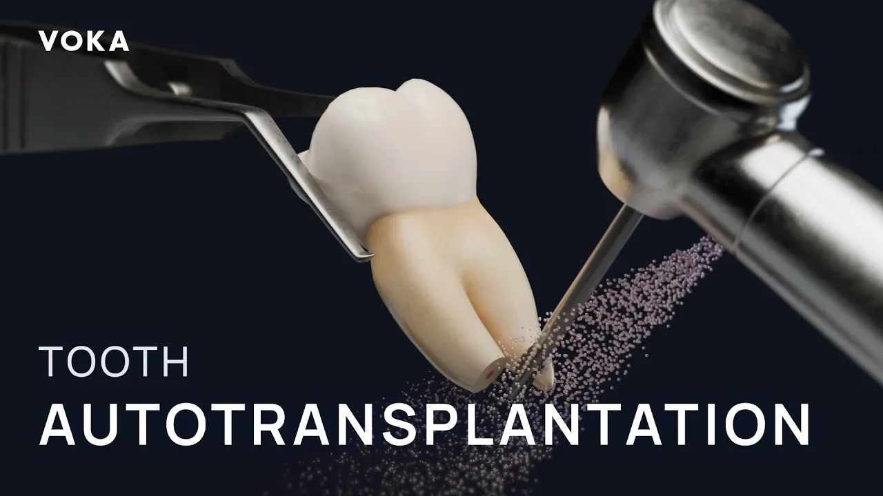 VOKA tooth autotransplantation animation