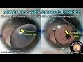 Download Lagu CataractCoach 1631: marfan syndrome and yamane IOL fixation