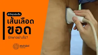 เส้นเลือดขอดเกิดจากสาเหตุอะไรบ้าง