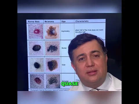 Melanoma Acral: O Perigo da Confusão #shorts