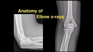 Download Anatomy of Elbow X-rays MP3