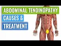 Abdominal Tendinopathy - Causes and Treatment Including Exercises