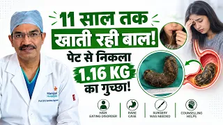 11 साल से बाल खाती थी 20 साल की लड़की! पेट में बना 1KG+ Hairball | Rare Trichobezoar Case