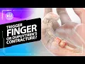 Lagu Triggerfinger versus de ziekte van Dupuytren: wat is het verschil? (3D-animatie)