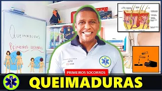 QUEIMADURAS PRIMEIROS SOCORROS - O QUE FAZER?