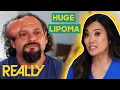 Download Lagu Dr. Lee Removes A HUGE Lipoma From A Patient's Head | Dr. Pimple Popper
