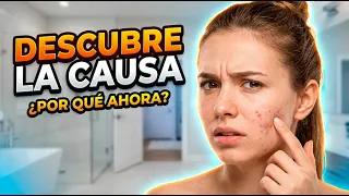 ¿Por qué tengo Acné? | Tu Salud Guía
